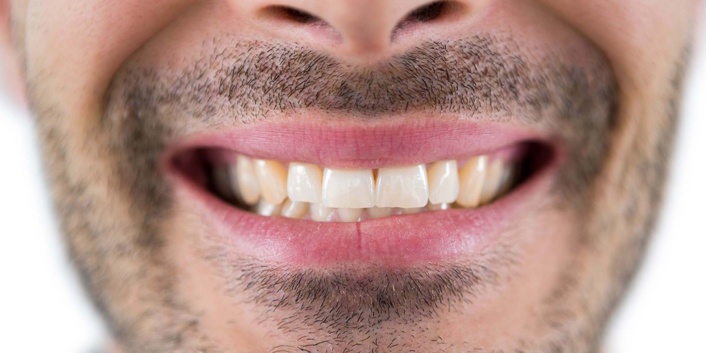 Before Teeth Whitening